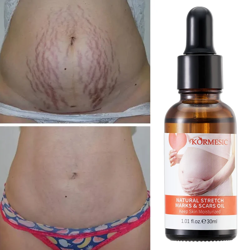 OEM ODM private label KORMESIC Stretch Marks Removal Oil Skin Firming Removes Scar Postpartum Stretch Mark Oil
