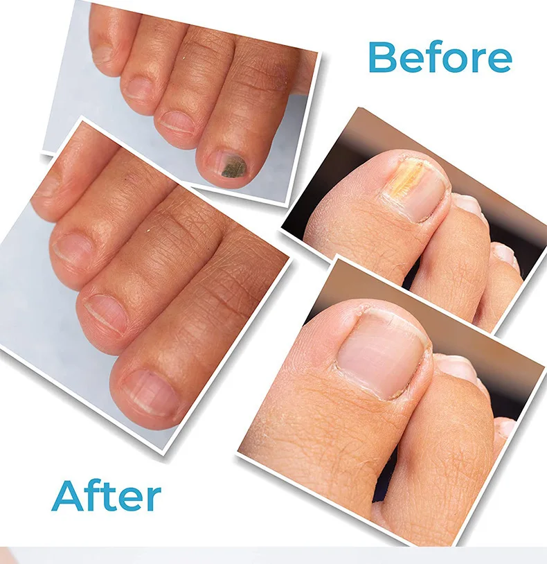 Newest Design Natural Herbal Onychomycosis Repair Liquid Nail Nail Fungus Treatment Pen