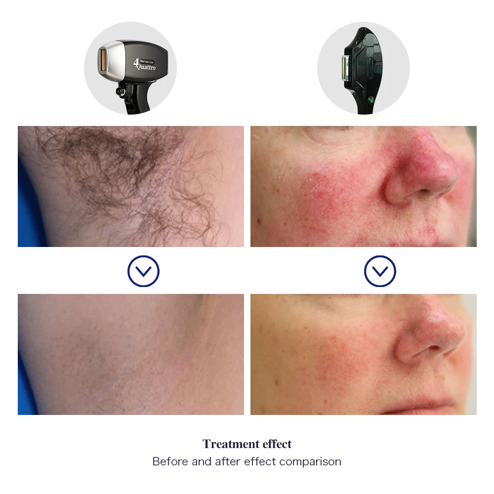 2in1 Ipl Laser 808nm Hair Removal Medical Diode Laser 3 Waves Permanent Multifunction Beauty Machine Stationary for Commercial