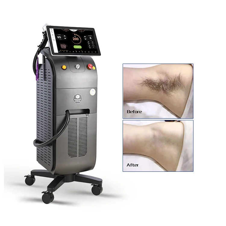 Titanium Laser Hair Removal Machine 2023 Ice Platinum Diode Laser Hair Removal 808 Diode Laser 755 808 1064 Ice Stationary 72KG