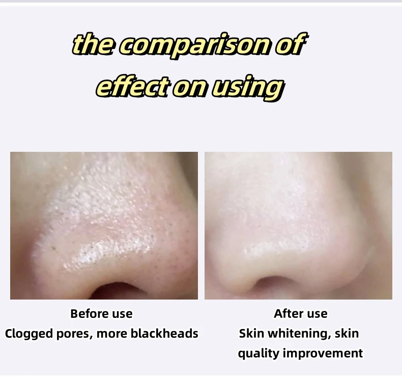 USB Beauty Machine Plastic Facial Cleansing Brush Vacuum Blackhead Remover Exfoliating Massaging Deep Pore Cleansing