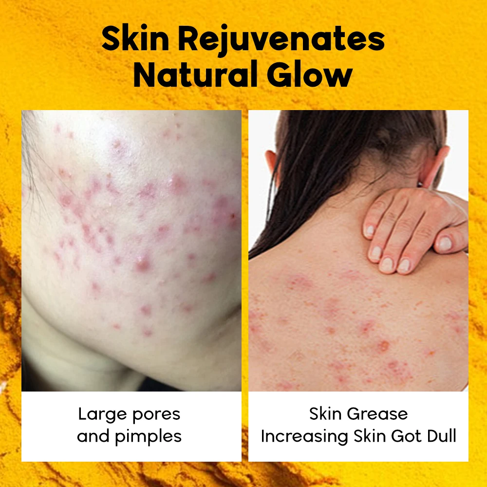 200g Private Label Turmeric & Vitamin C Whitening Soap Herbal Anti-Acne & Antiseptic for Adults