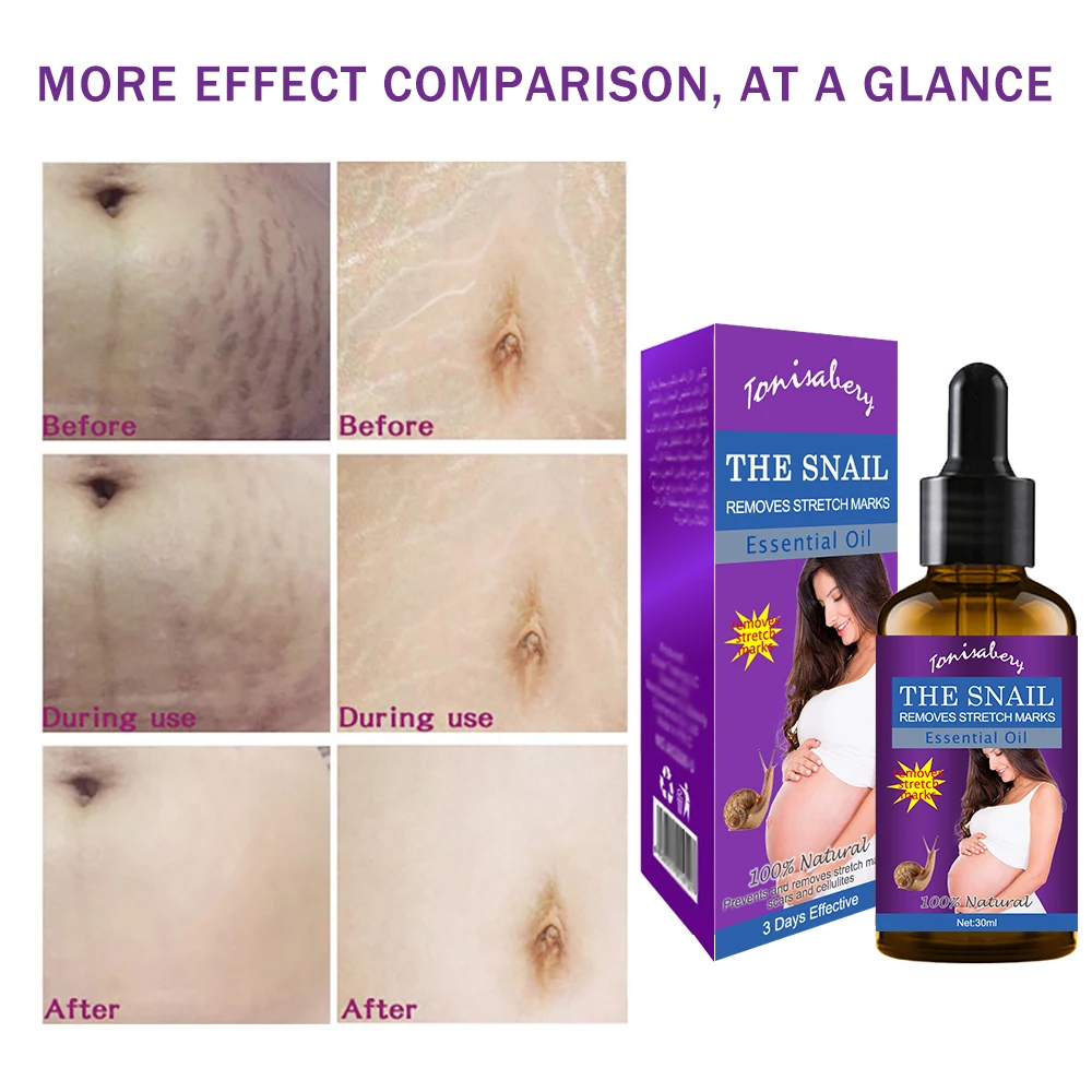 
Stretch Marks Remover Oil Skin Care Treatment Cream For Stretch Mark Removal Maternity Slackline For Pregnant Oils 30g 