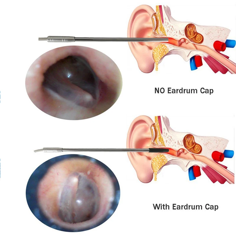 Medical USB Endoscope 4.9mm Lens for Ear Nose for OTG Android Phone PC Borescope Inspection Otoscope Endoscope Camera