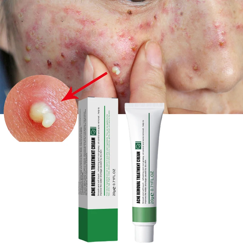Private Label Organic Azelaic acid Aloe Vera Acne Treatment Scar Removal Acne Cream