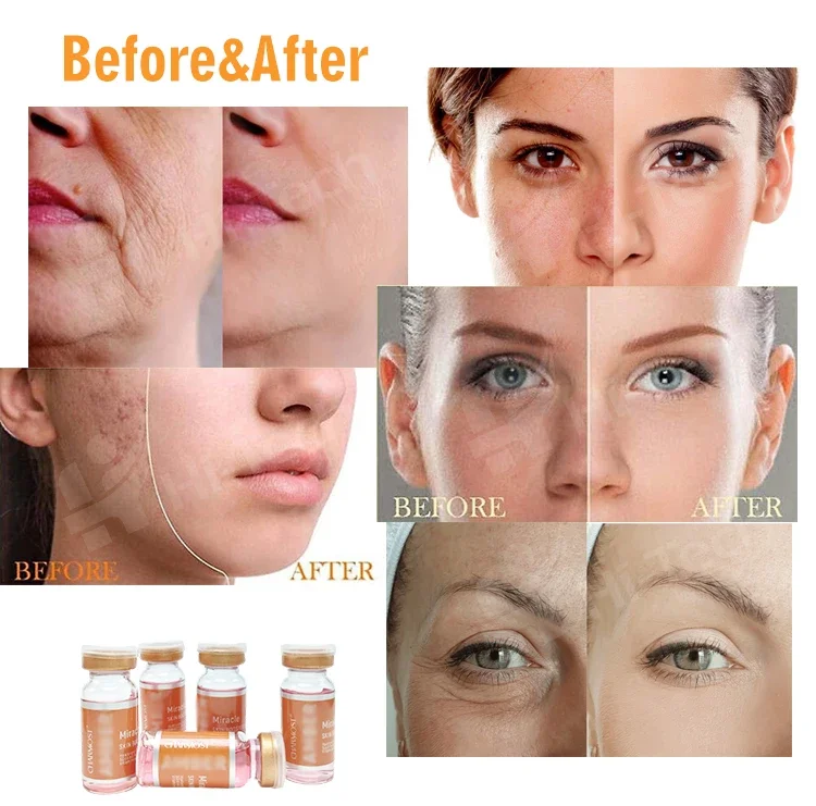 High Quality 10ml Facial Acid Anti Acne Skin Repairing Face Skin Care Microneedling Skin Whitening  Meso Serum