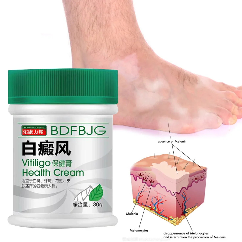 30g Vitiligo Ointment for Body White Spots Pigmentation Itchy Skin Body Moisturizing Herbal Extract Cream