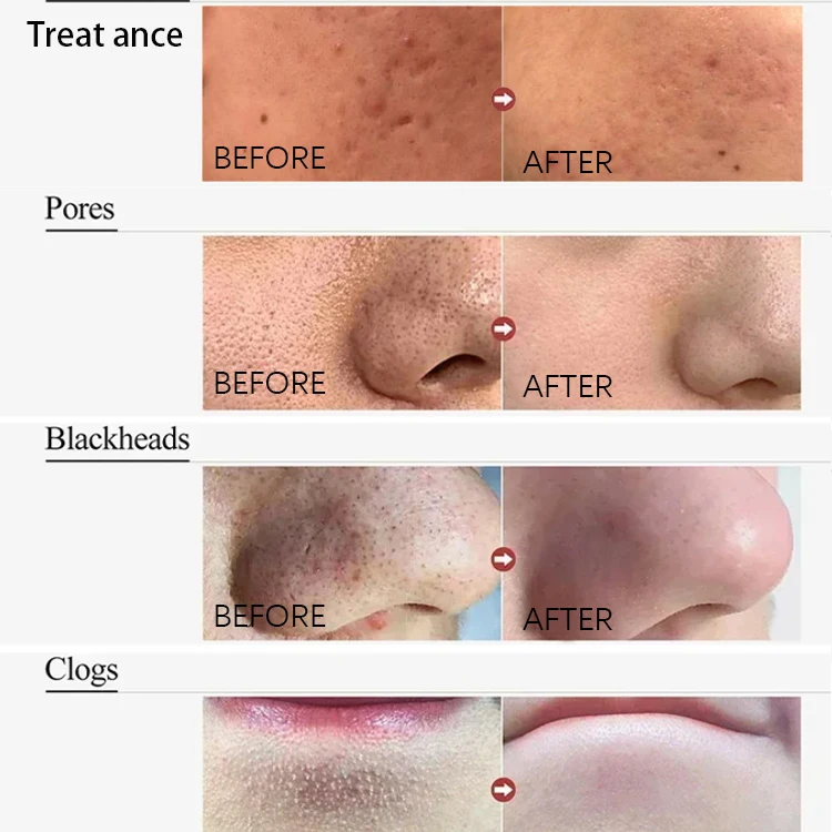 acne treatment men face wash facial cleanser clean and clear Fade acne marks Acne treatment azelaic acid face wash