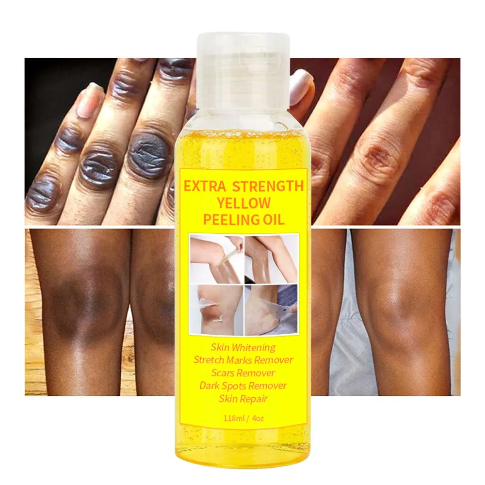 OEM Super Strength Yellow Peeling Oil Lighten Elbows Knees Hands Melanin Bleaching Dark Skin Strong Peeling Oil