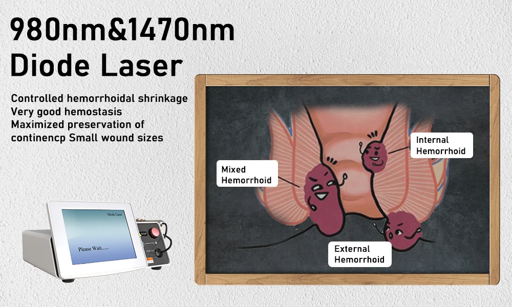 Medical Hemorrhoids Laser Machine 980nm 1470nm Diode Laser Germany Urology Laser Fistula Surgery Device Rectal Proctology