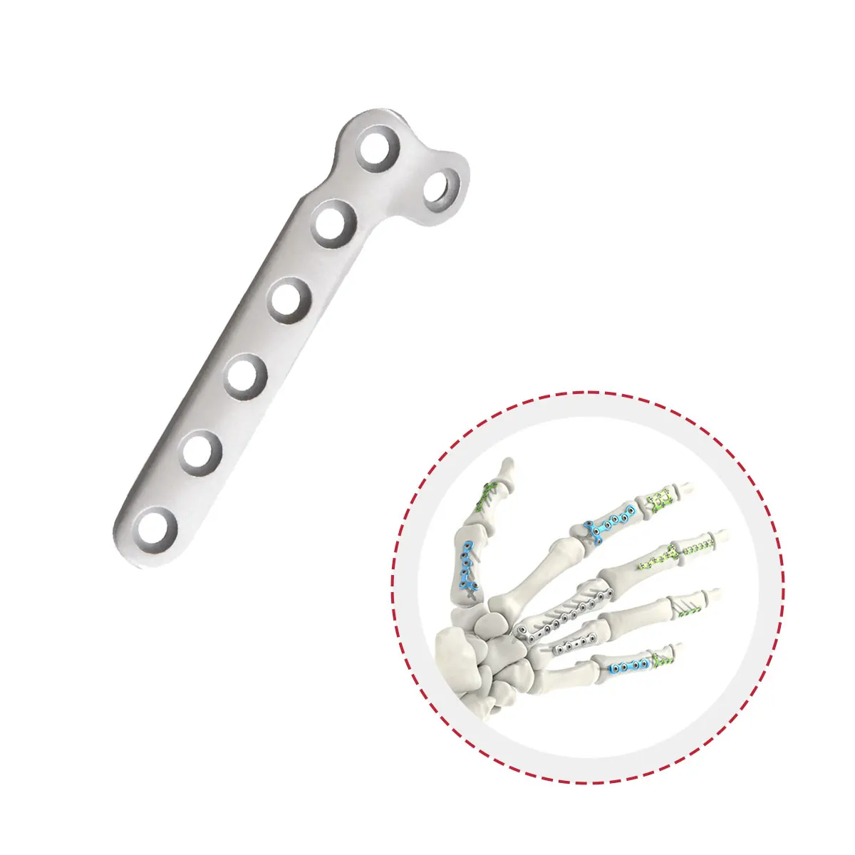 Titanium Metacarpal Phalange Finger Fracture Hand Locking Anatomical L-Plate for Metacarpal