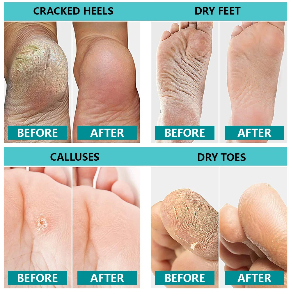 Anti-cracking Foot Cream Dry foot mask Foot heel cracking repair balm Moisturizing hand cocoon removal dead skin Heel Balm