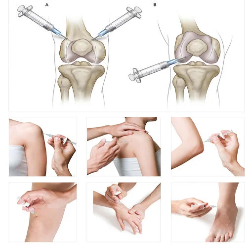 Knee joint injection knee hyaluronic acid hyaluronic acid injection knee cross link