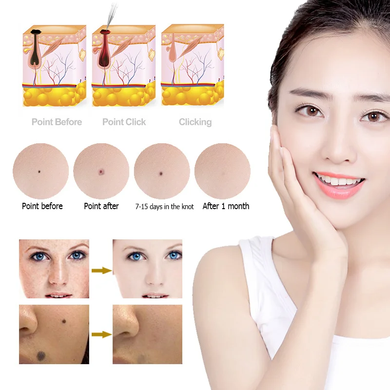 Electronic High Tech Skin Tag Eliminator Moles Warts Removal Plasm Pen Black Spot Warts Eliminator For Skin Beauty