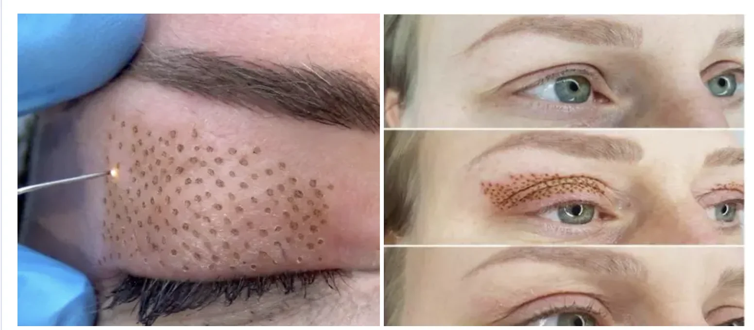 Medical 3 in 1 fibroblast ozone plasma pen jet plasma lift eyelid plasma shower for acne scar removal skin tightening