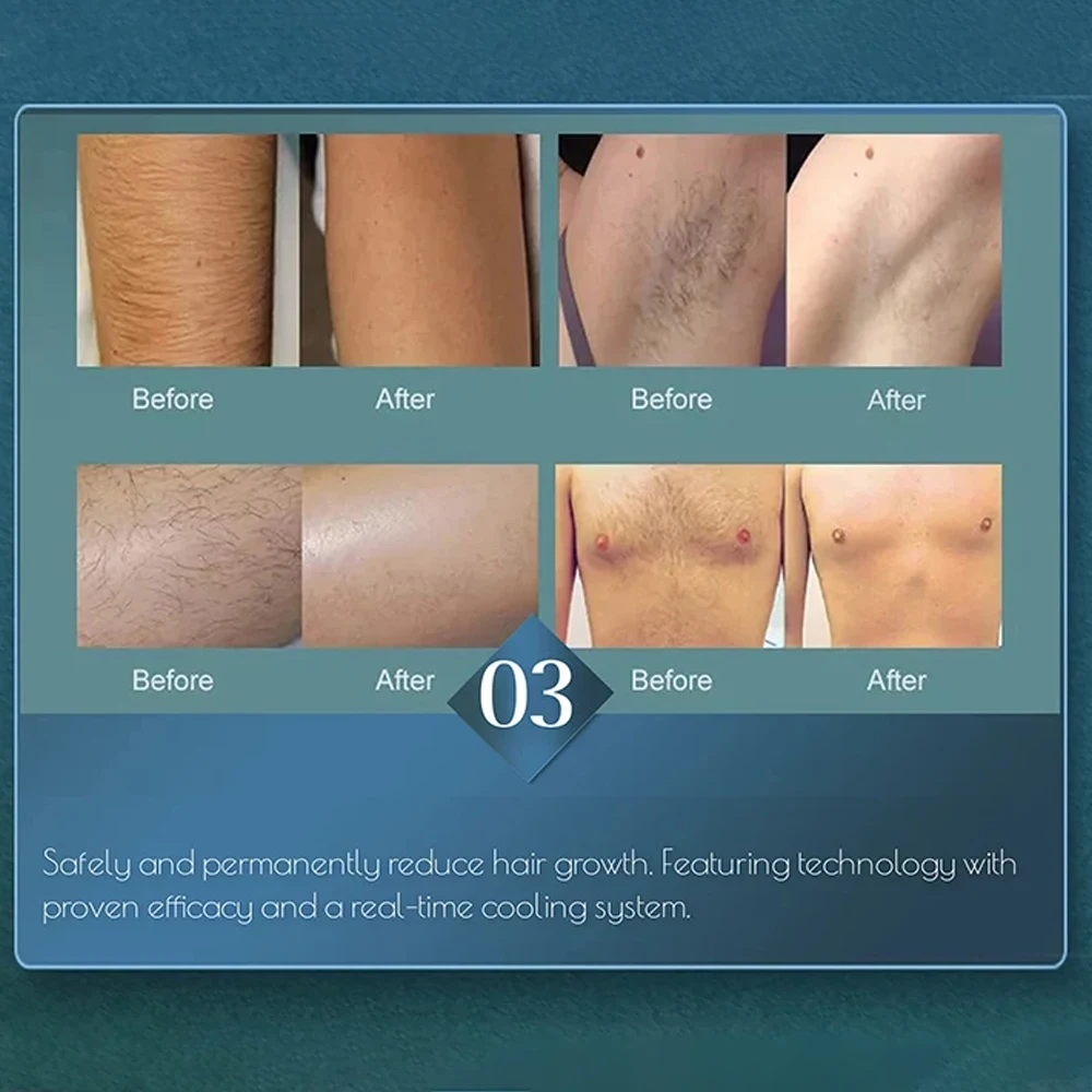 wholesale laser hair removal hair removal laser Machine diode laser hair removal machine 808