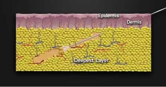 Liposuction structure.png