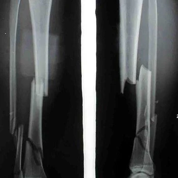 China Kenid Medical dry X-ray films 10*12inch thermal blue dry X-ray digital printable films