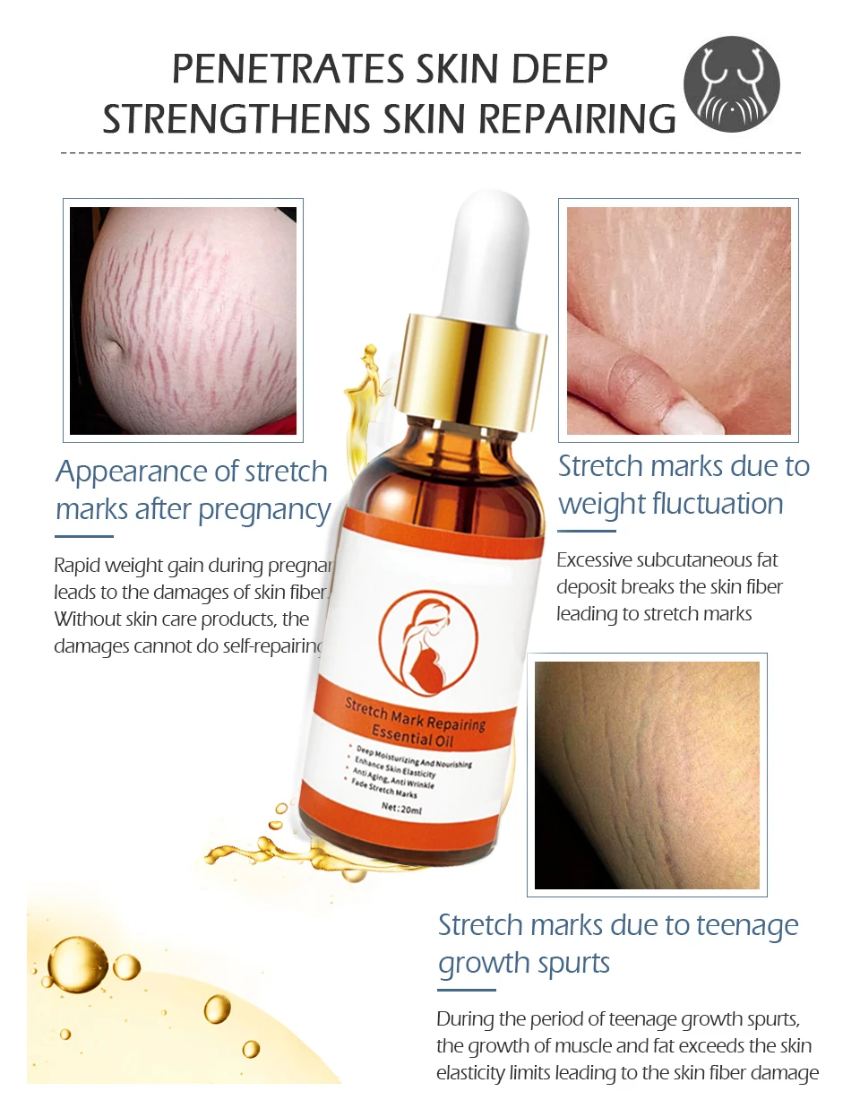 Stretch Marks Remover Essenti al Oil Skin Care Stretch Mark Cream For Stretch Mark Removal Maternity Slackline For Pregnant Oils