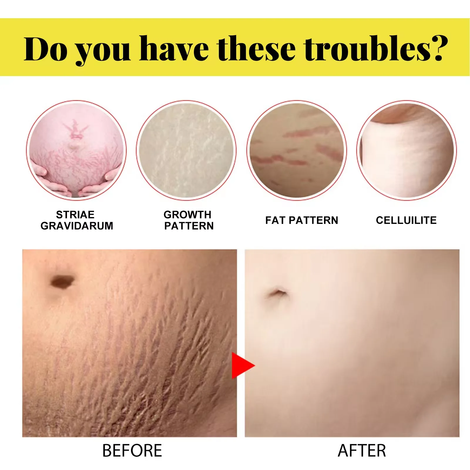 Improve Skin Relaxation Improve Skin Relaxation Stretch Marks Scar Removal Cream After Pregnancy Anti Stretch Mark Cream
