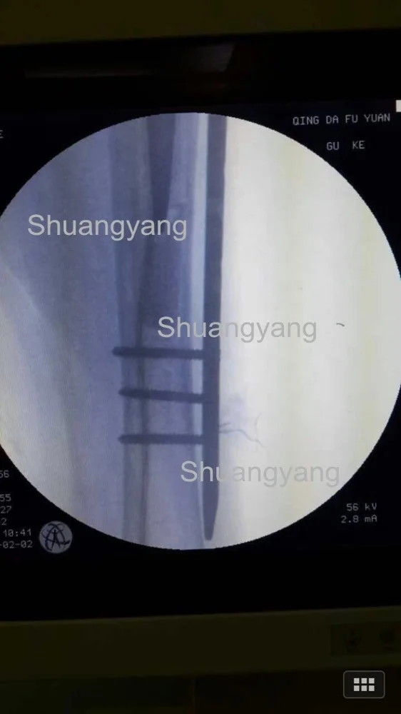Titanium cable and locking plate Implant for Orthopedic femur fractures (Cerclage Wire)