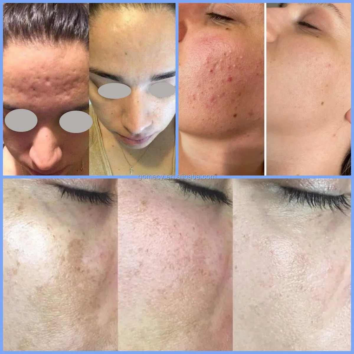 rf-micronee-fractional-beauty-machine-golden-micro-needle-3-in-1-skin-tightening-morpheus-8