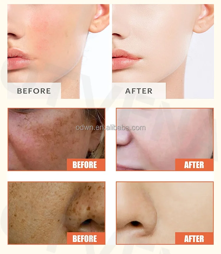 Hot Selling 100% Effective Moisturize Skin Dark Spots Freckle Removal Whitening Cream