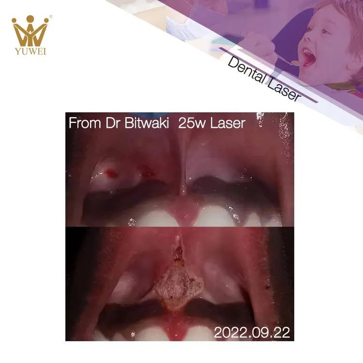 Hot Sale Dental Low Level Dental Laser 980nm 30w Dental Hard Tissue Laser Whitening Machine Price Dental Soft Tissue Laser