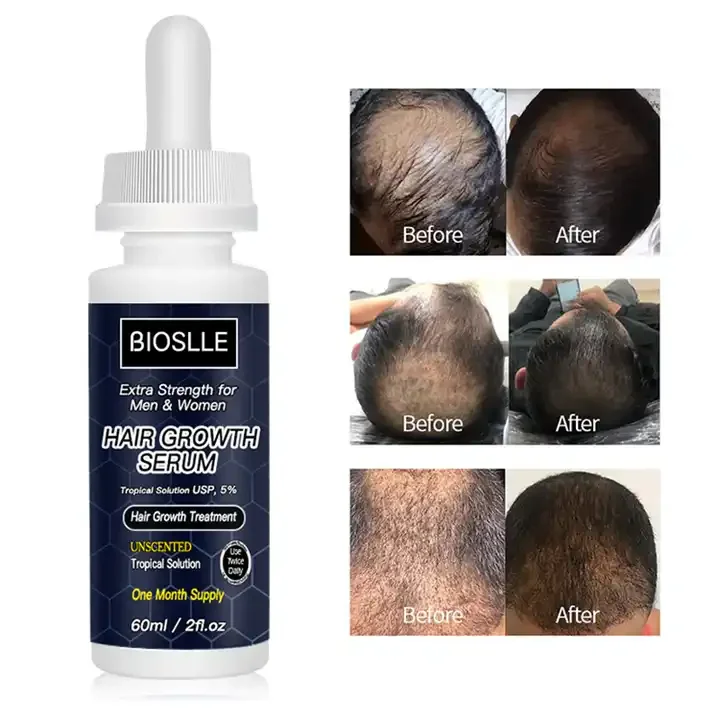 Private Label Hair Care Treatment Growth Oil Agent Prevents Hair Loss Nourishing Growth Serum Fast Hair Regrowth Tonic