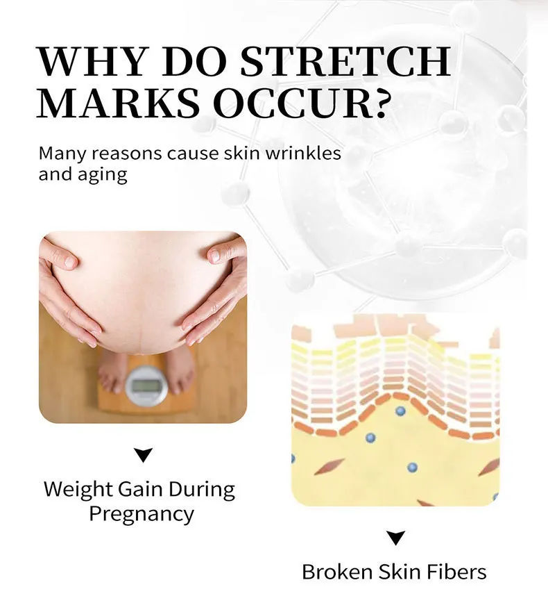 OEM ODM Natural Organic Mango Stretch Mark Repair Cream Maternity Fades Postpartum Fat Growth Orange Peel Scar Remover Skin Care