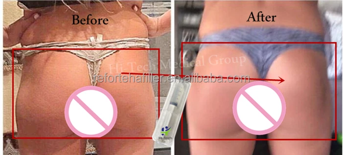 Hot-selling Injectable Cross Linked Hyaluronic Acid Syringe Ha Filler Injection Dermal Filler