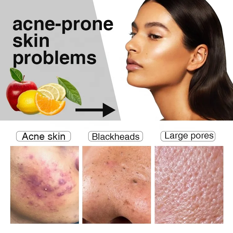 ailke wholesale best salycilic acid acne pimple face brightening anti-acne serum facial