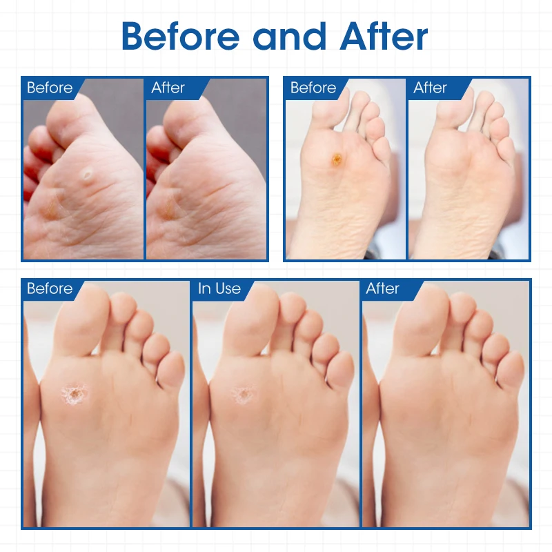 HOT SELL Cost- effective Chinese herbal hand and foot pain relief hansaplast non woven corn removal plaster oem odm