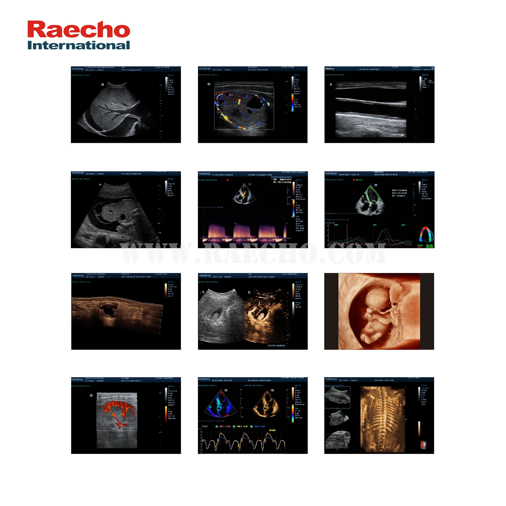 Mindray Optical Electronic Trolley Diagnostic Ultrasound Machine