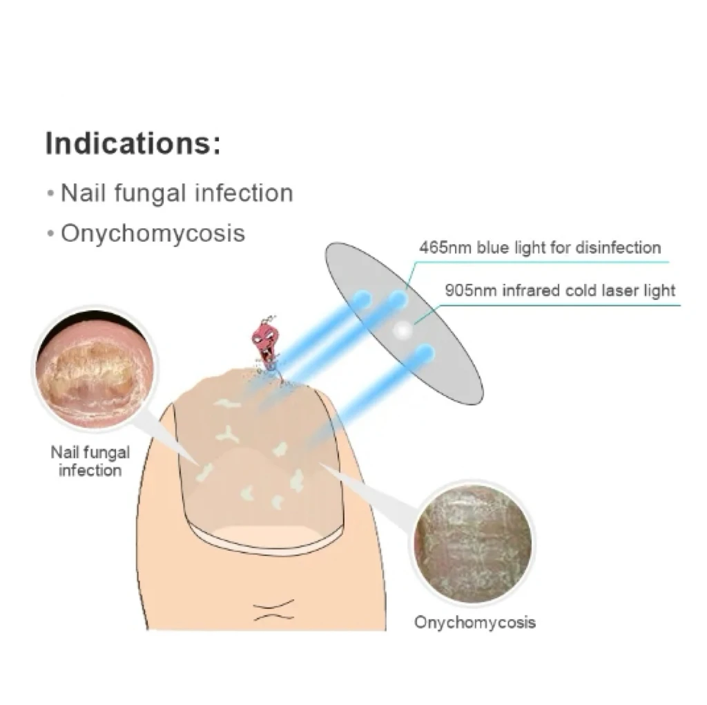 Hot New Product Semiconductor Cold Laser Nail Fungus Treatment Device