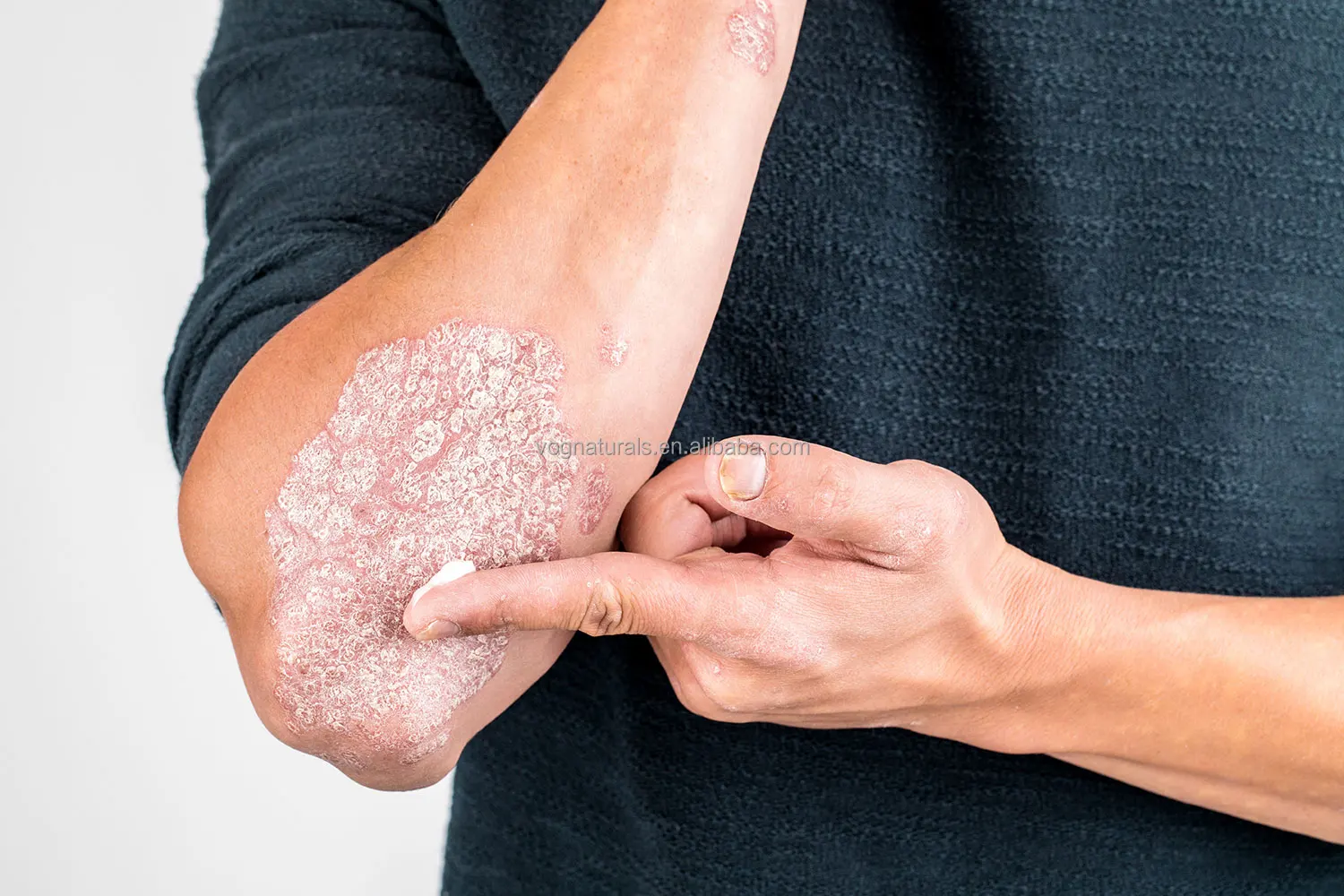 eczema cream 13.jpg