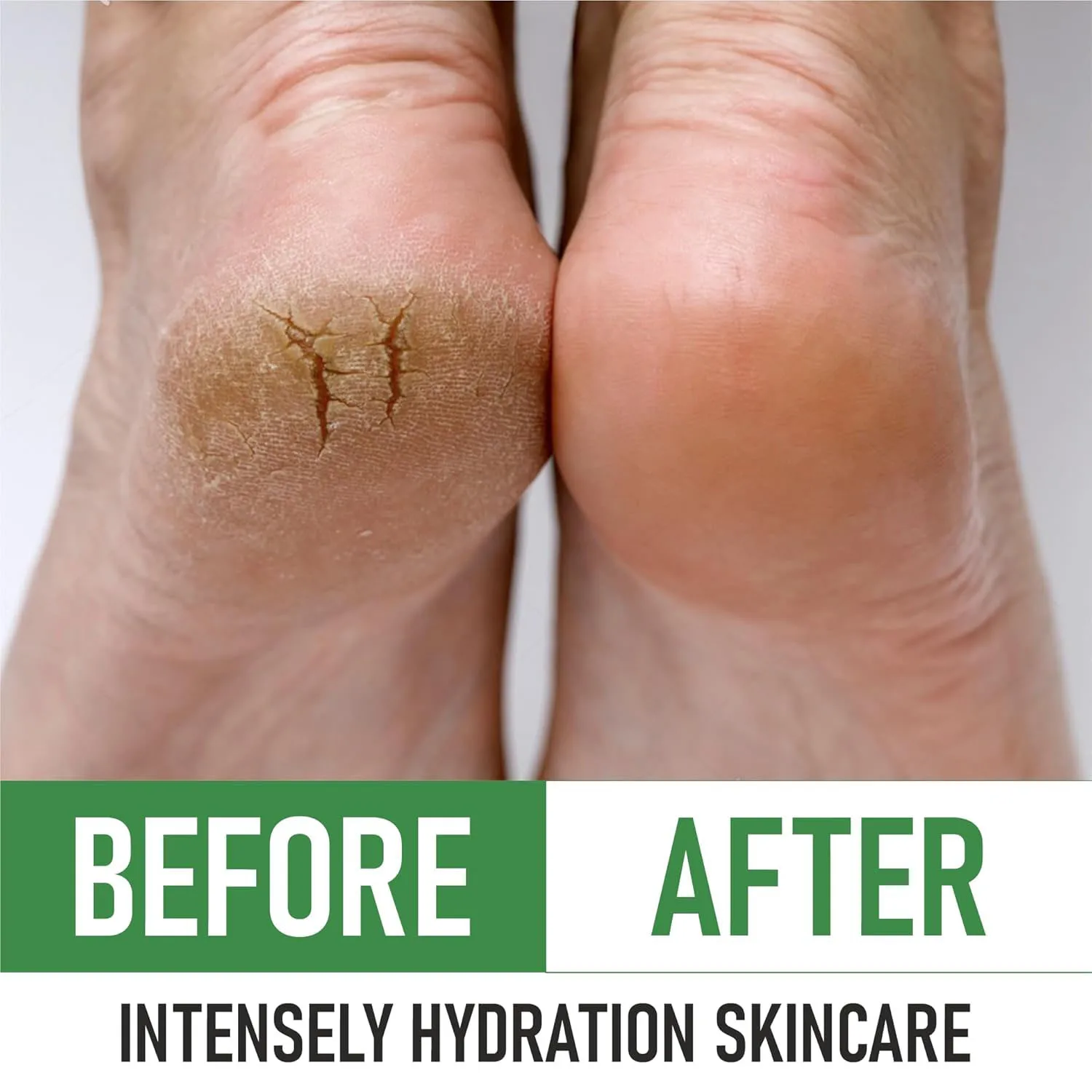 Urea 40% Cream Foot Cream Dead & Dry Skin Corn Callus and Dead Skin Remover Softener Moisturizer For Feet Elbows Hands and Knees