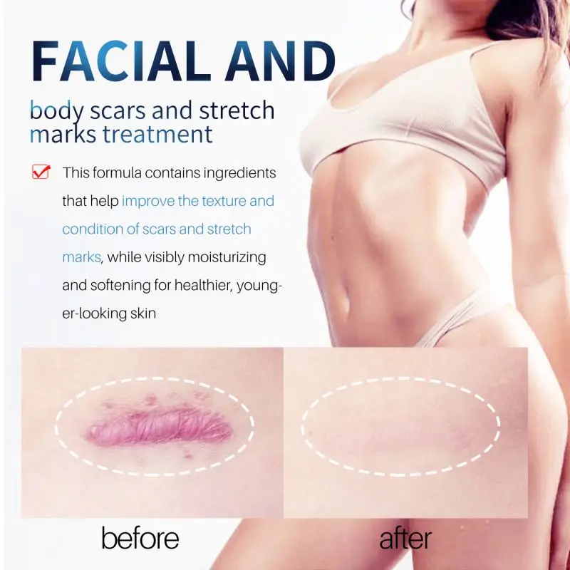 30g Old And Dark Spot On Leg Removal Cream Remove Postoperative Effectively Prevents Scar Proliferation After Surgery