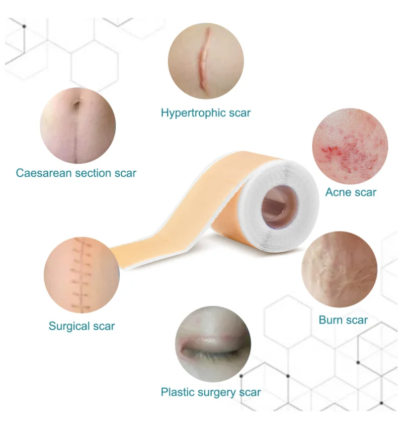 High Quality Roll Shape 4cmx1.5M silicone scar sheets New products Factory Price Silicone Gel Scar Away Sheets for Scars removal