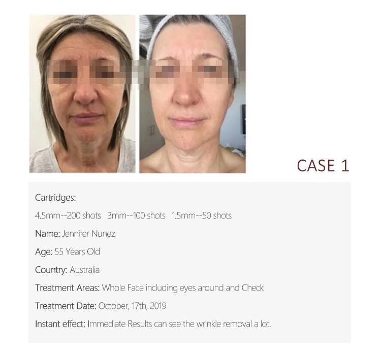 Dual Handle 2 in 1 Painless 11 Line 4D 5D Hifu Cartridge 100 000 Shots Smas Treatment Machine Facial