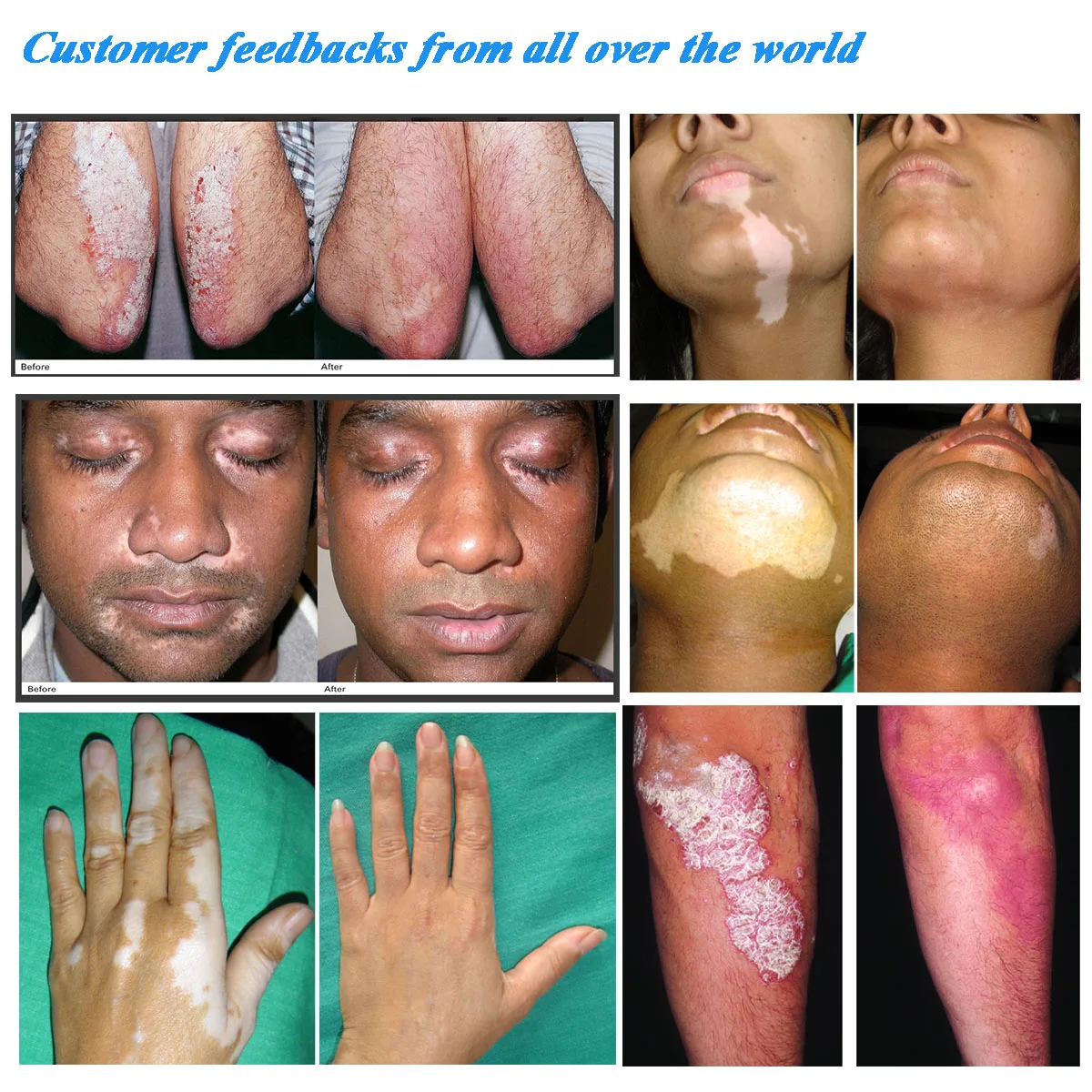 device unit price uv lamp led uvb phototherapy excimer laser 308nm psoriasis vitiligo 311nm uvb psoriasis