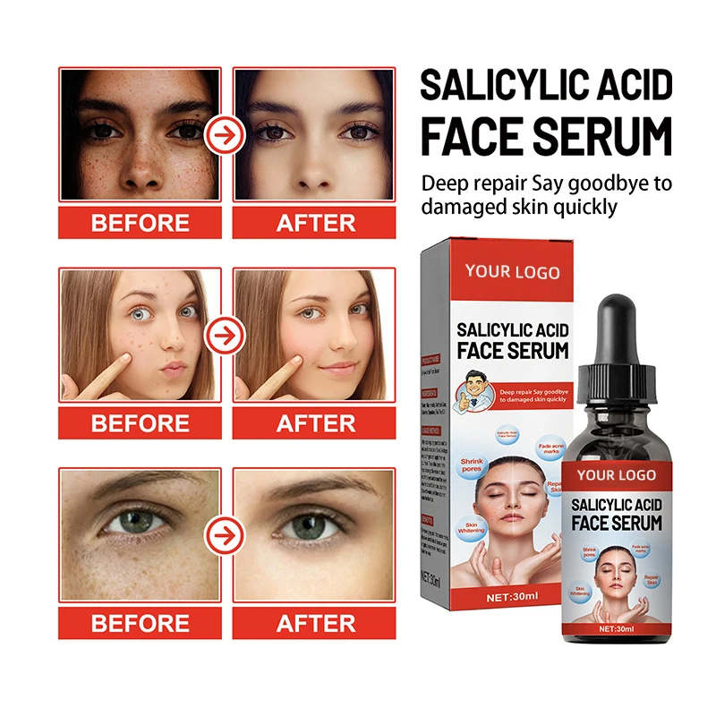 Nicotinamide Freckle Removal Serum with Salicylic Acid Shrinks Pores and Moisturizes Face OEM Supply Skin Care Products