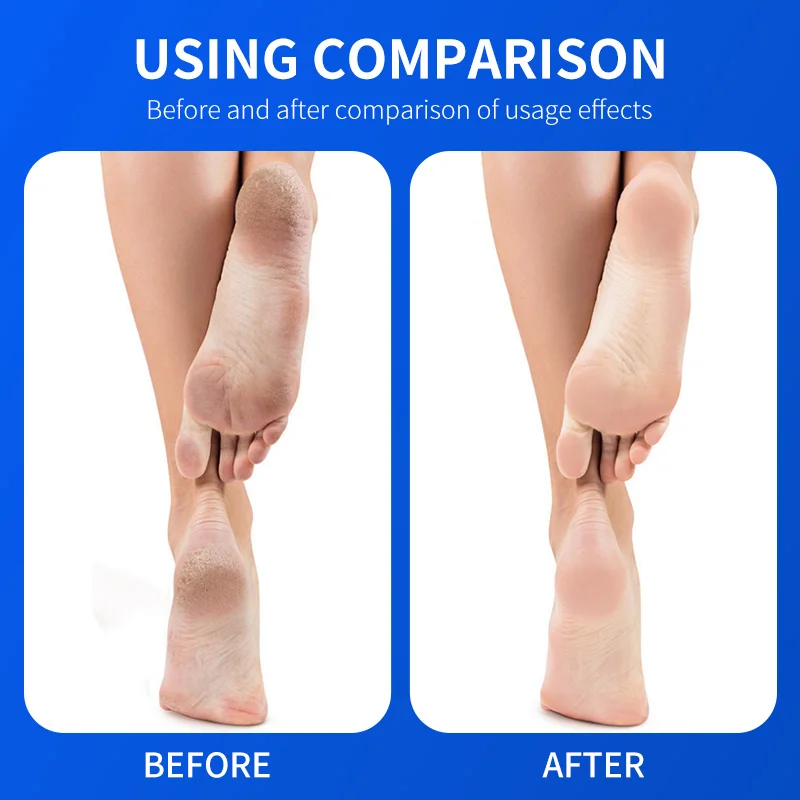 OEM Deep Moisturizing Cream 2% Salicylic Acid Gently Removes Dead Skin & flakes Urea Foot Cream