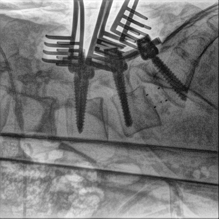 WeMed Mobile C arm x ray system with durable X ray release switches