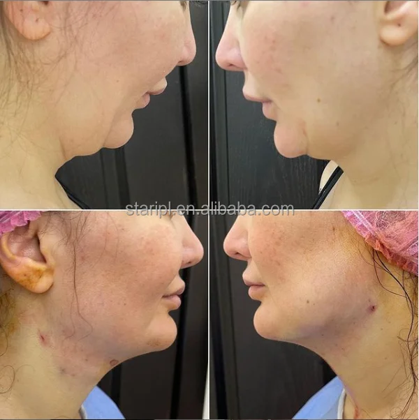 Fiber Endolaser Lipolysis Facial Body Lifting 980 1470nm Diode Laser Liposuction Canulas Fat Dissolving Medical Surgical Machine