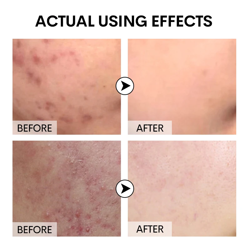 Private Label Organic Natural TEA TREE FACE SERUM For Skin Repair MoisturizingAustralian tea tree loofah essential oil soap