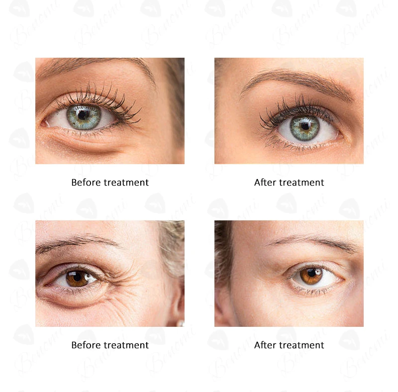 Latest lymph Lymphatic Drainage device Cellulite Reduction Inner Roller Slimming  Muscle Massage Facial Skin Tightening Machine