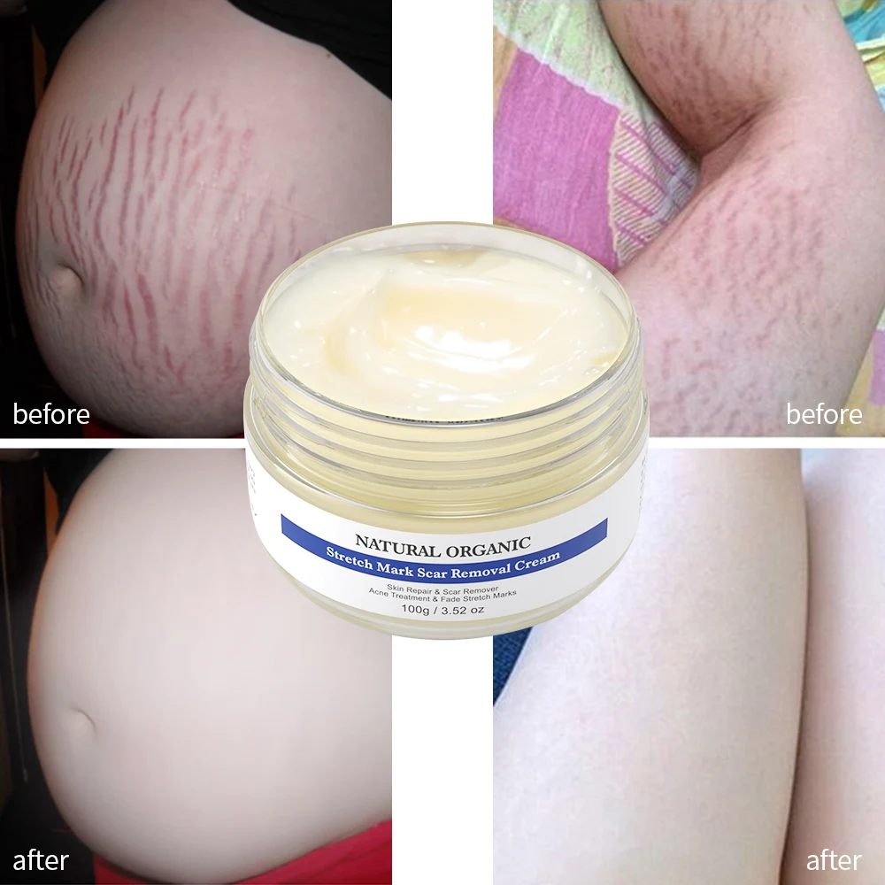 stretch mark cream natural organic stretch mark repair cream private label