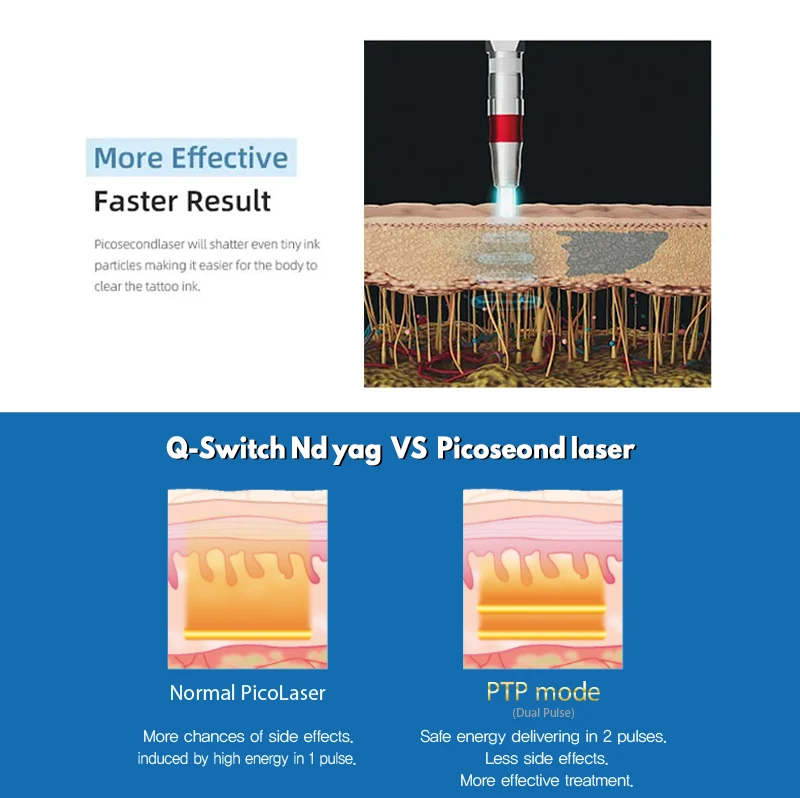 Professional Q-switch Diode Picosecond Laser Machine with 4 Wavelength for Tattoo Removal Machine for Salon