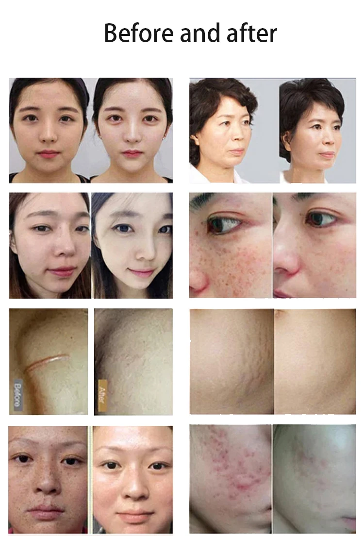 Portable Fractional Rf Microneedle Machine Radio F Replacement Heads For Gold Rf Microneedling Gold Rf Crystallite Depth 8